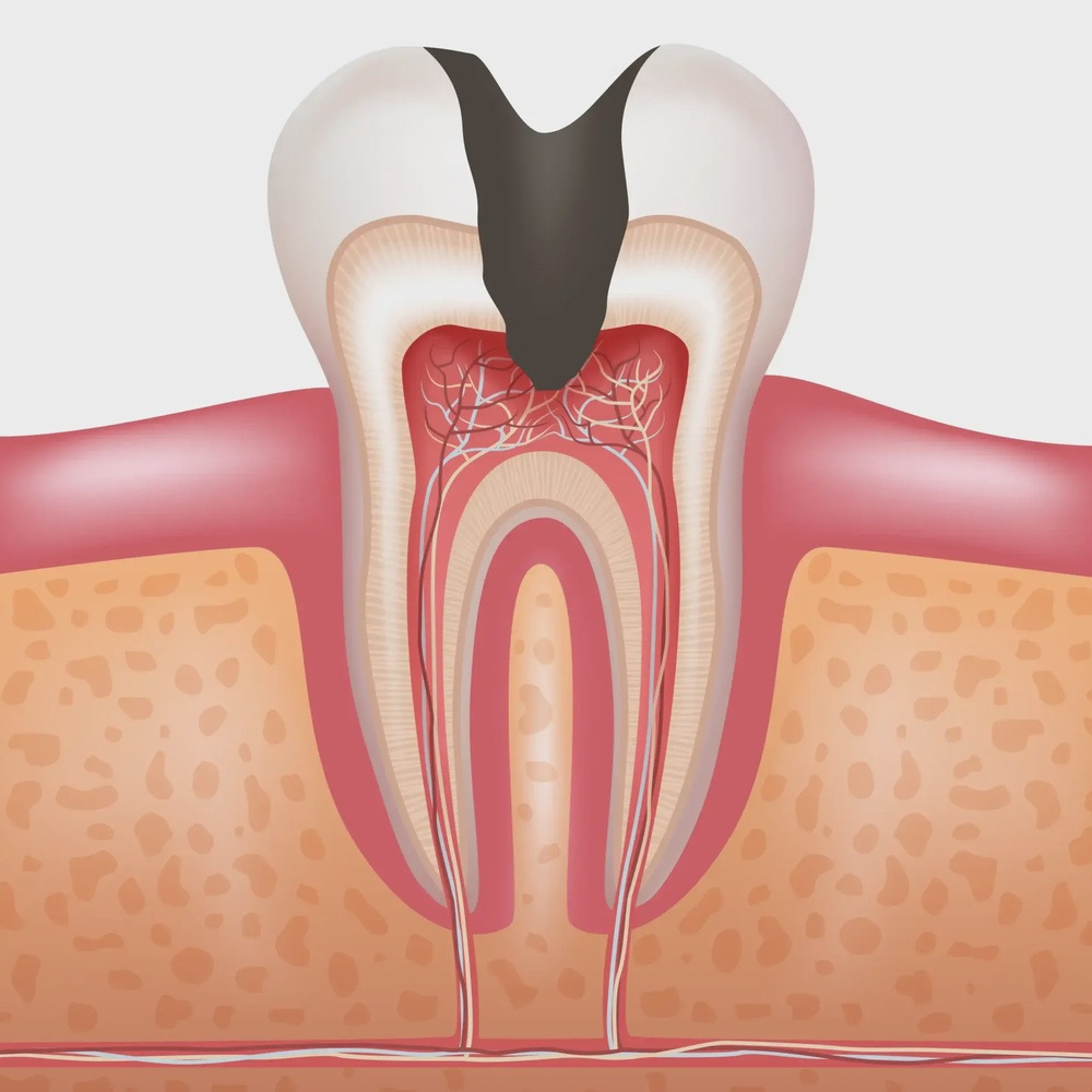 Лечение пульпита