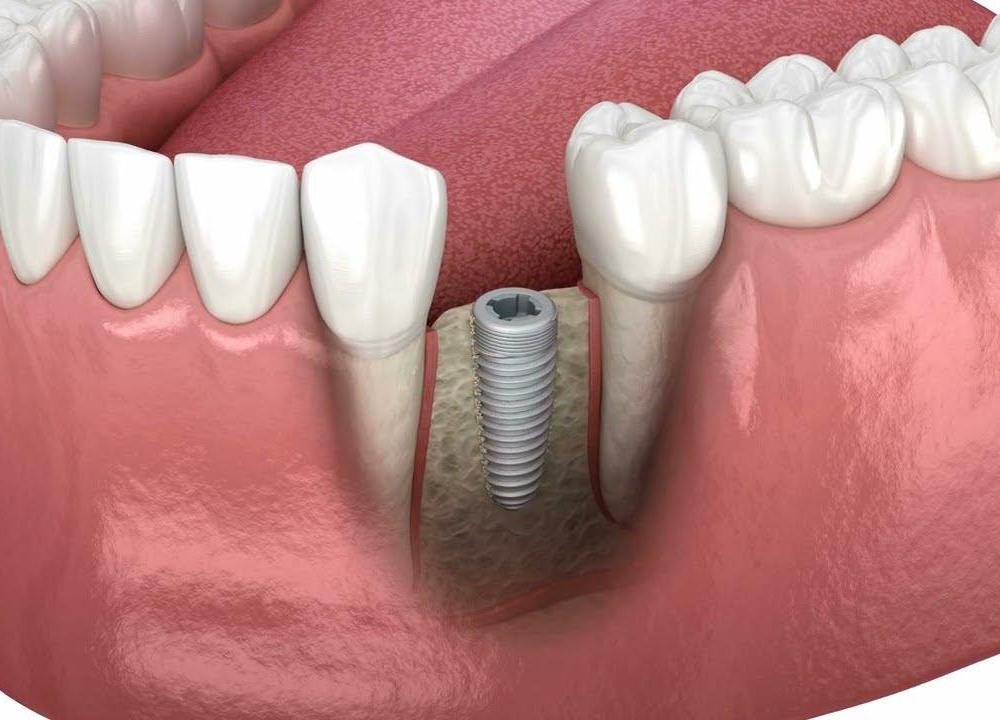Внутрикостная имплантация