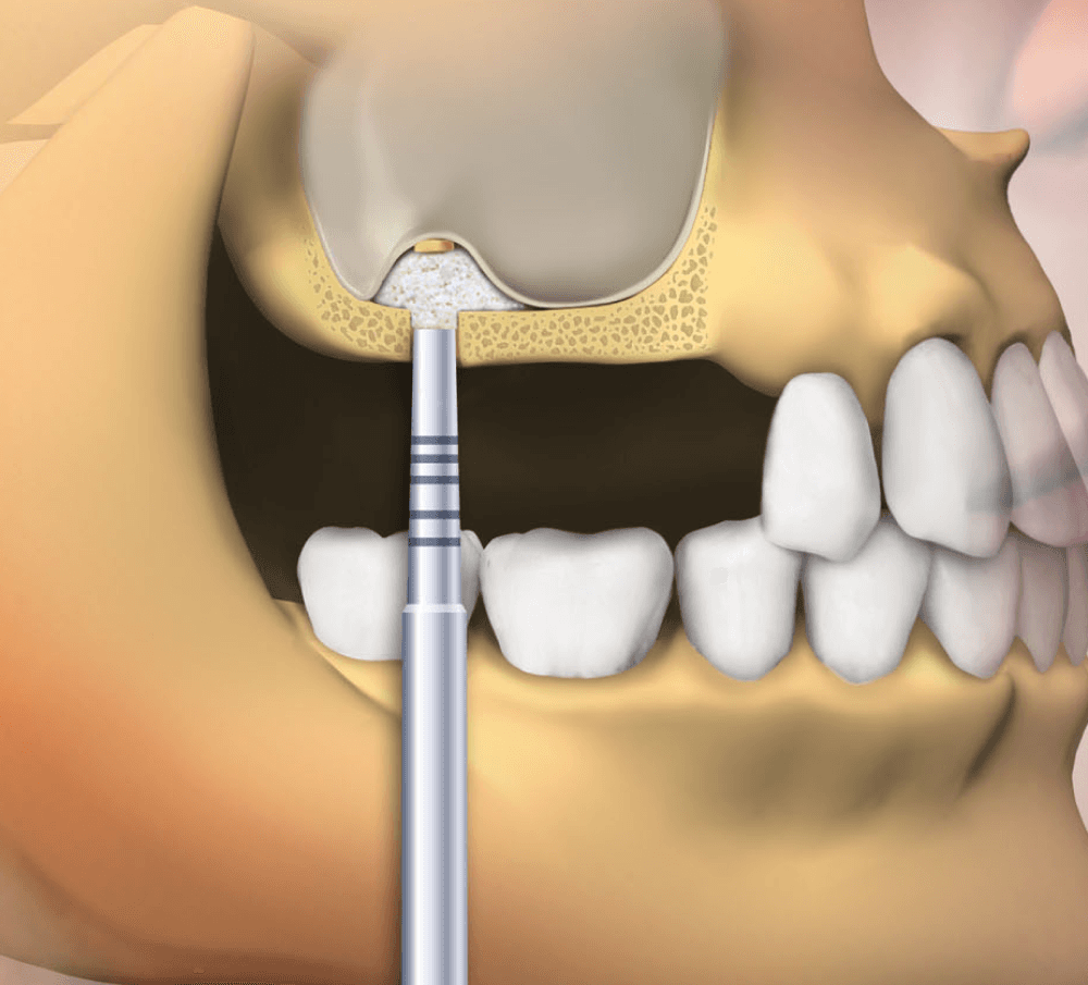 Открытый и закрытый синус-лифтинг