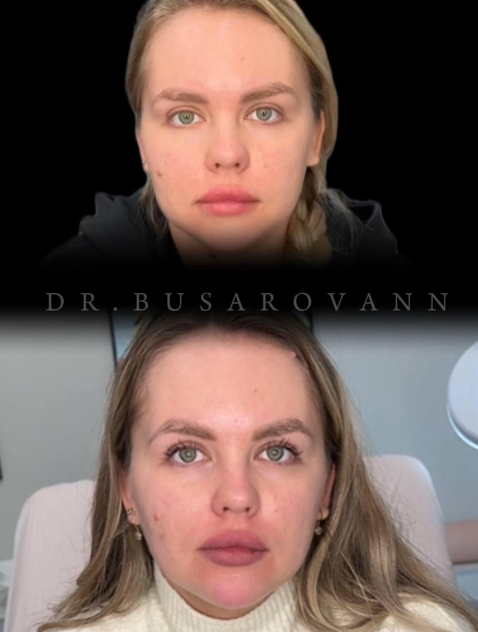 Ботулинотерапия (Ботокс)