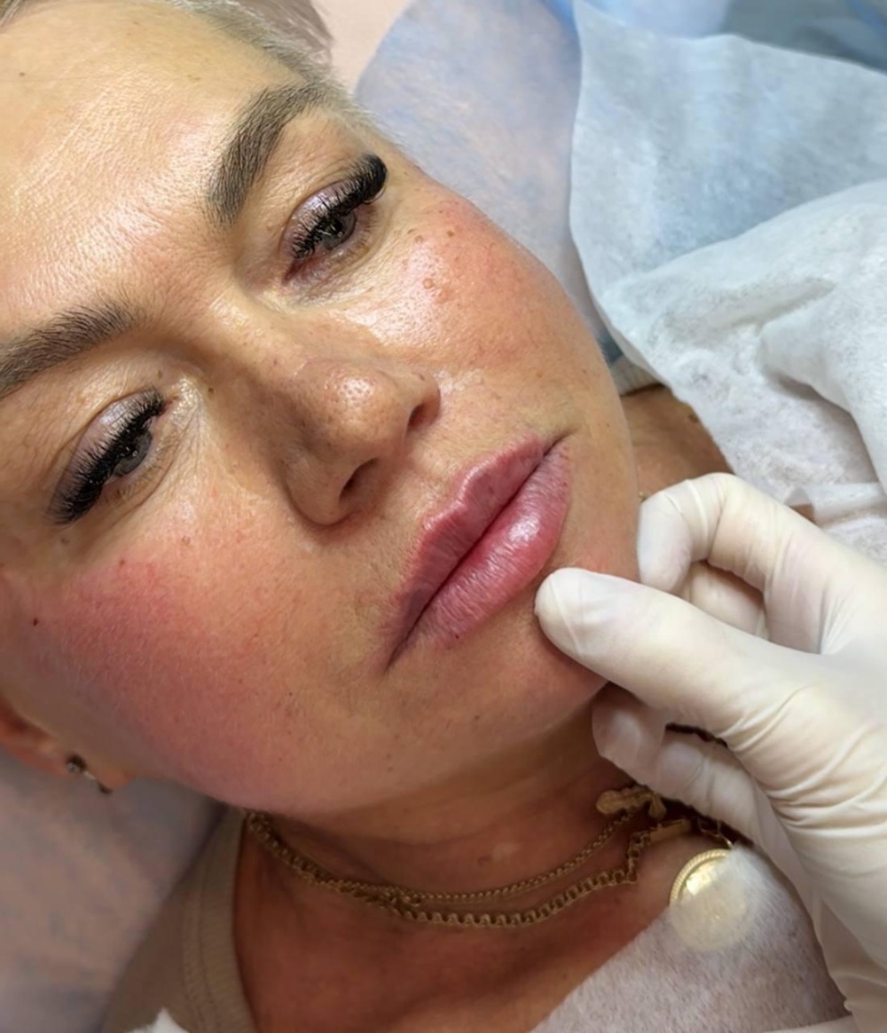 Контурная пластика губ