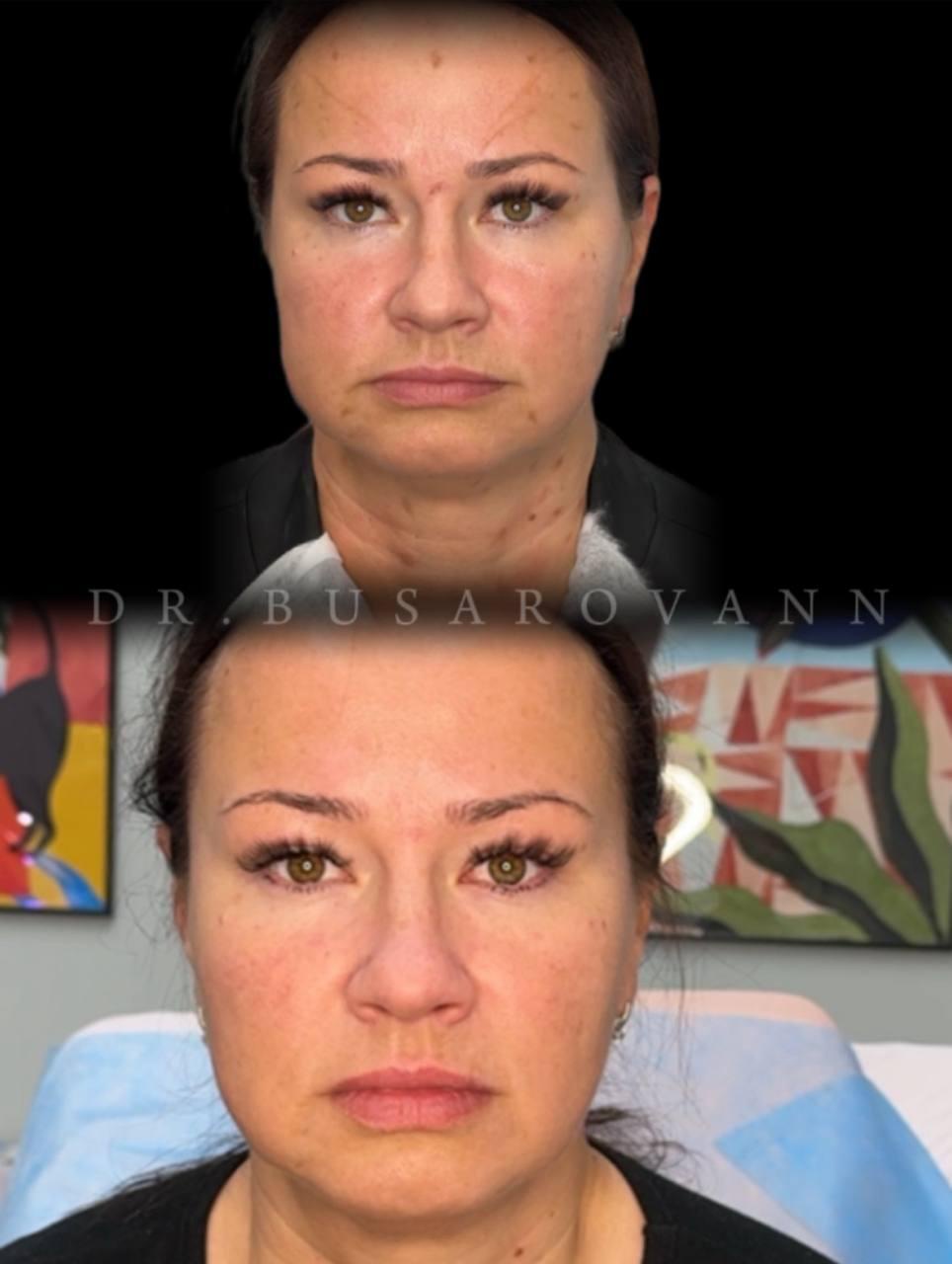 Ботулинотерапия (Ботокс)