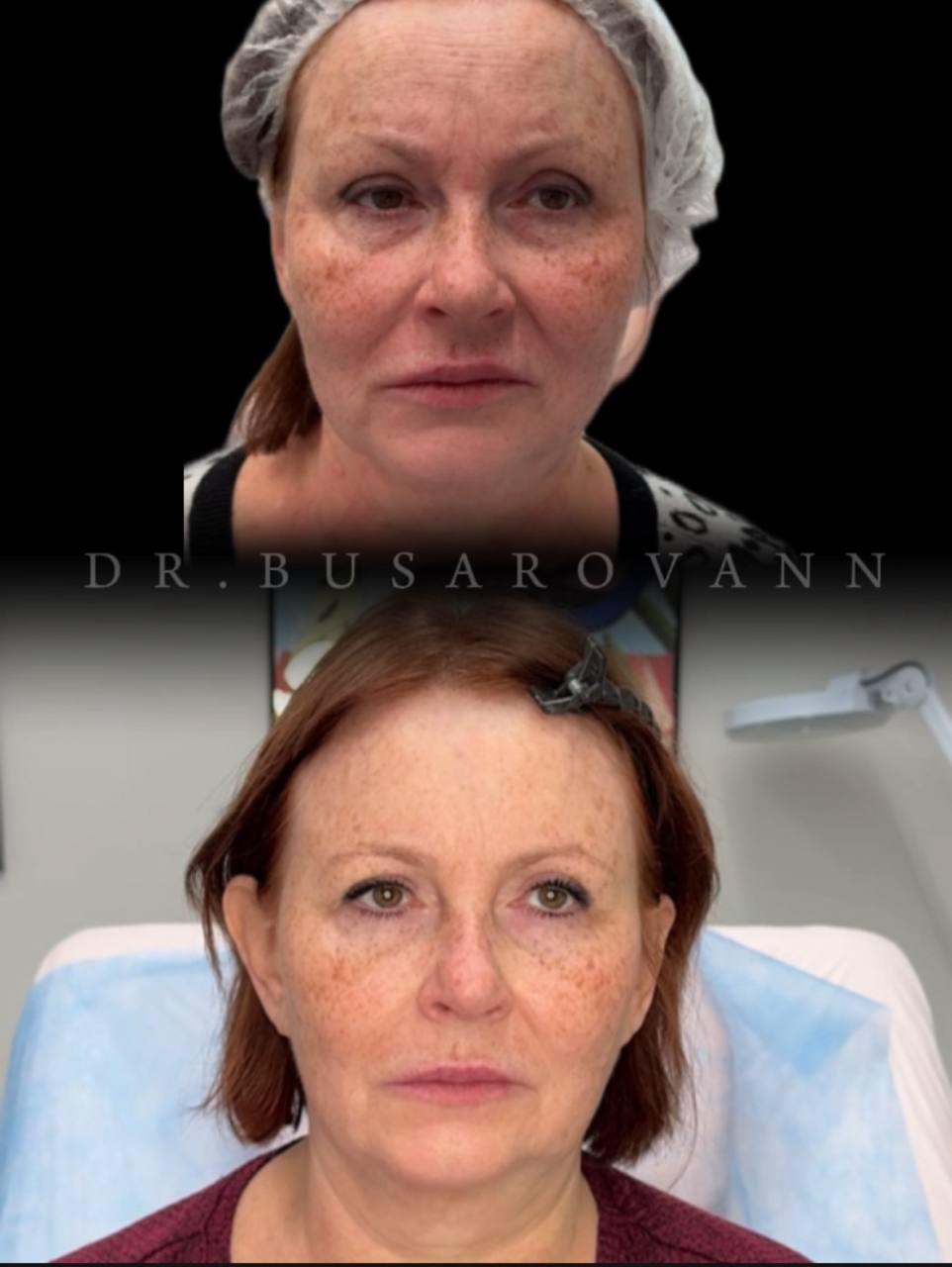 Ботулинотерапия (Ботокс)