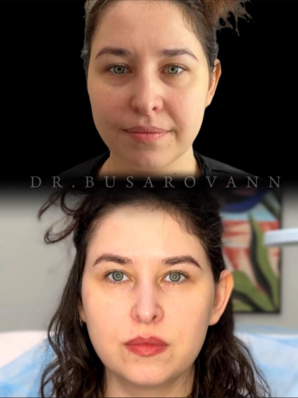 Ботулинотерапия (Ботокс)