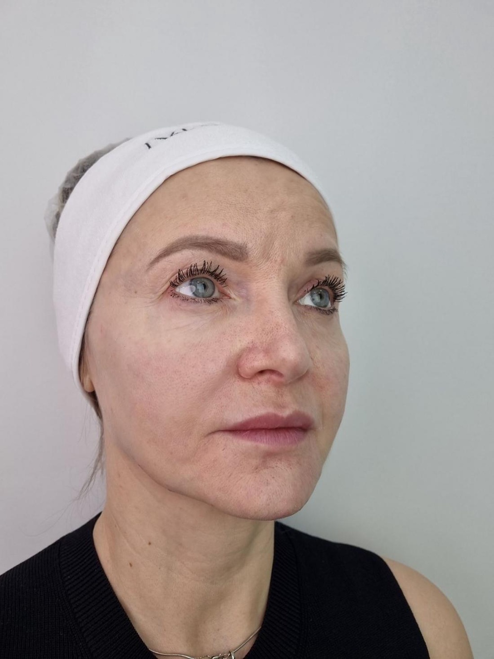 Коллагенотерапия и Коллагеностимуляция