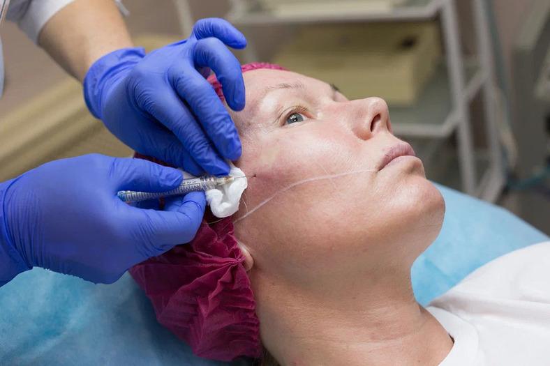 Векторный лифтинг PLLA