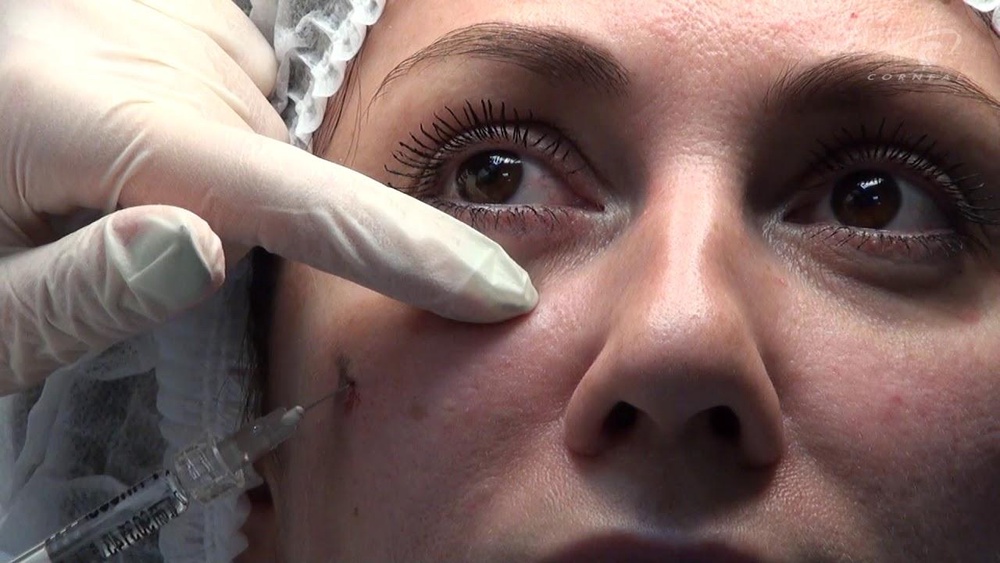 Контурная пластика носослезной борозды