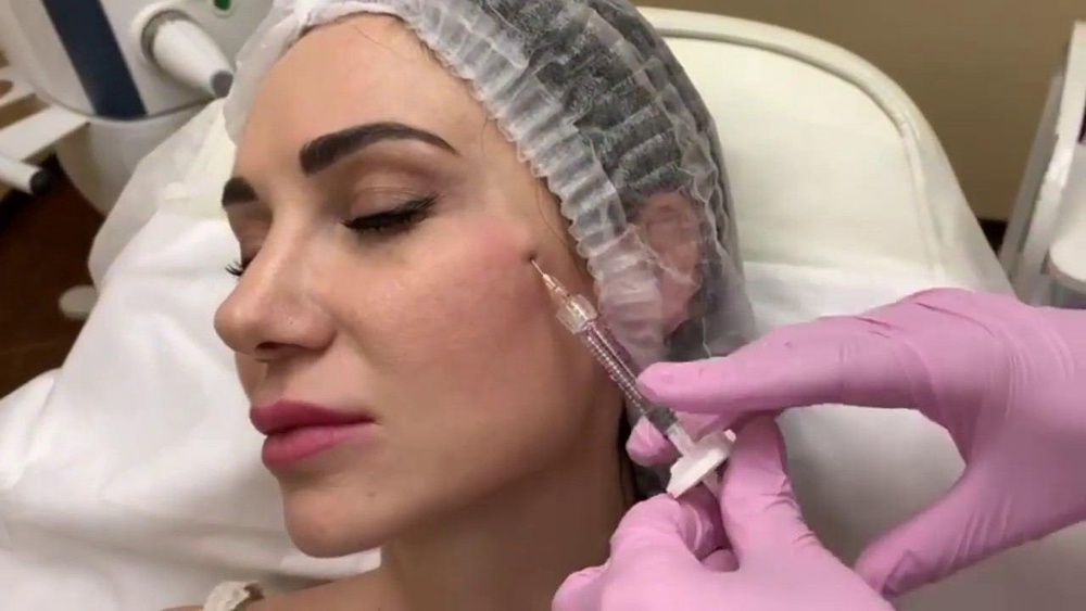 Контурная пластика висков