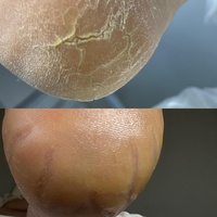 Восстановление стоп и ногтей