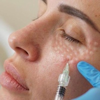 Биоревитализация