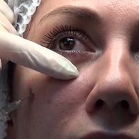 Контурная пластика носослезной борозды