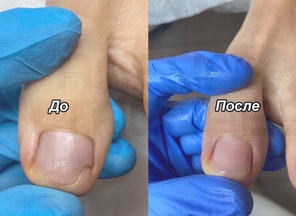 Онихолизис. Лечение.