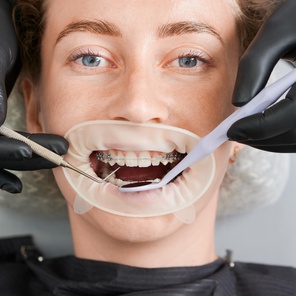 Реставрация зуба светоотверждаюшим материалом