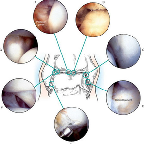 Артроскопия