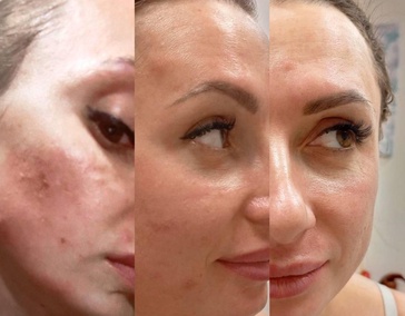 Лечение акне 