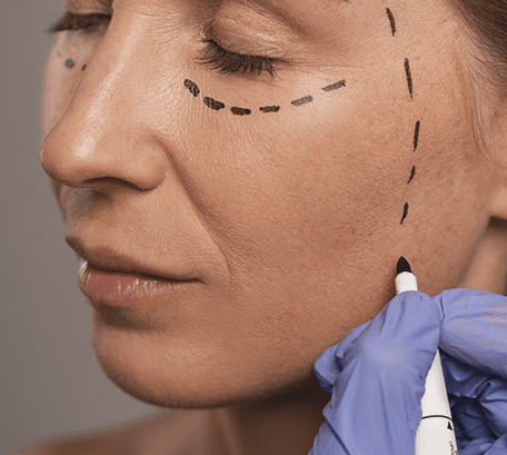 Тредлифтинг Full Face в Челябинске — подтяжка лица без скальпеля и без разрезов