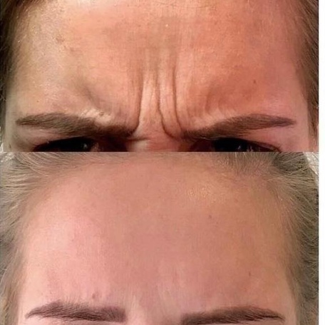 Ботулинотерапия в Челябинске — разглаживание мимических морщин без операции и без «заморозки» лица